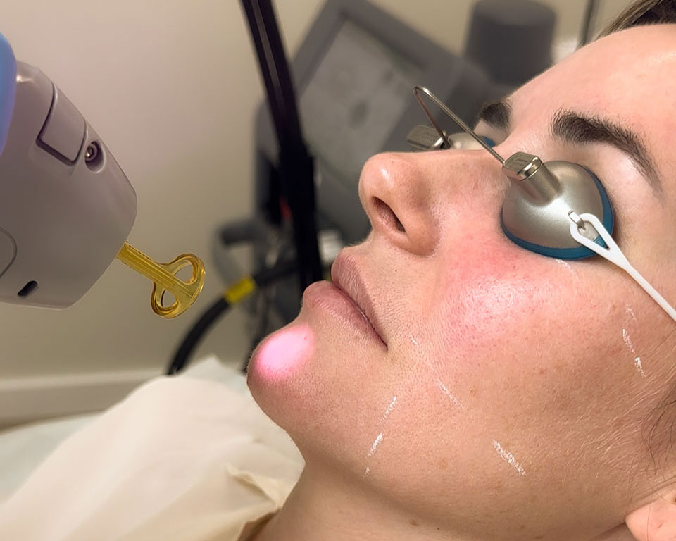 laser facial near me