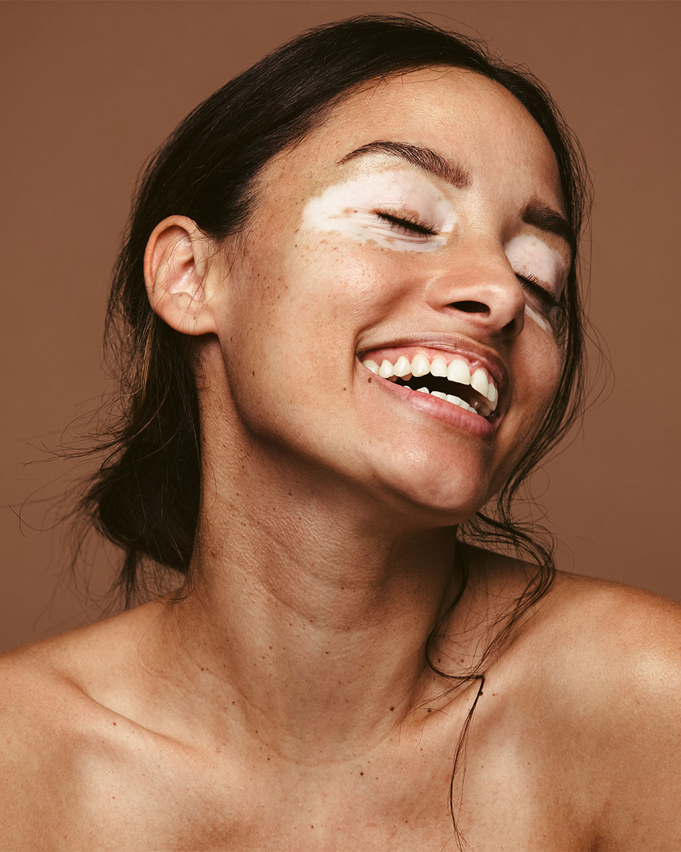 laser facial pigment correction