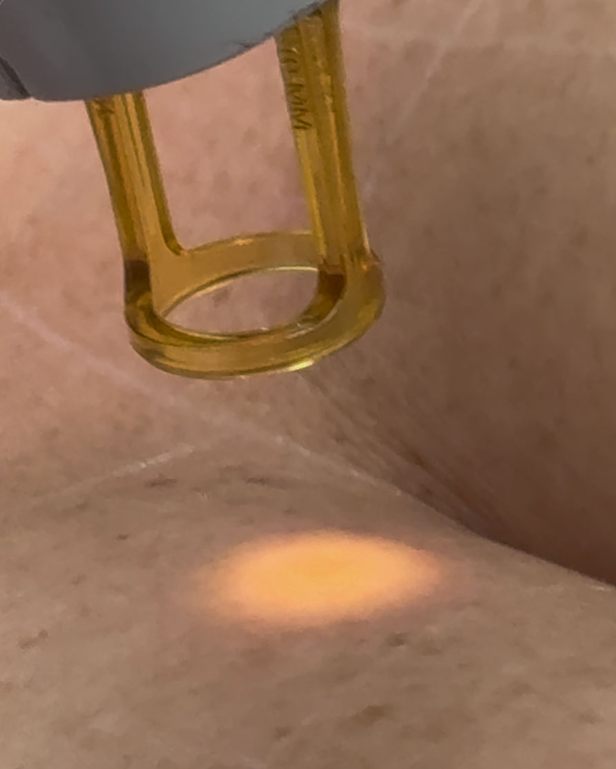 laser pigmentation